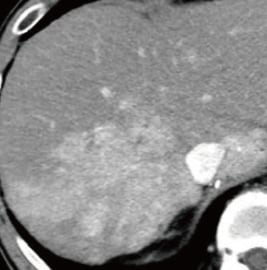 Contrast CT images, arterial phase