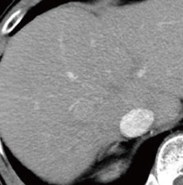 Contrast CT images, arterial phase