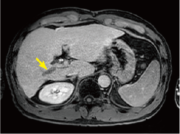 Hepatobiliary phase