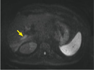 Diffusion-weighted image