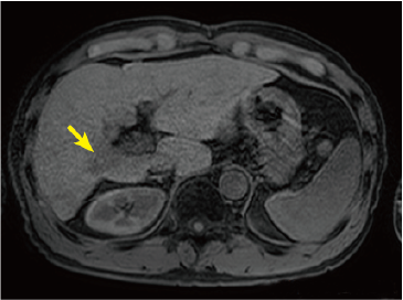 Pre-contrast T1-weighted image