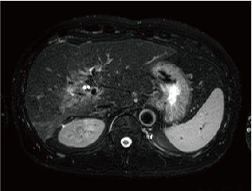 T2-weighted image