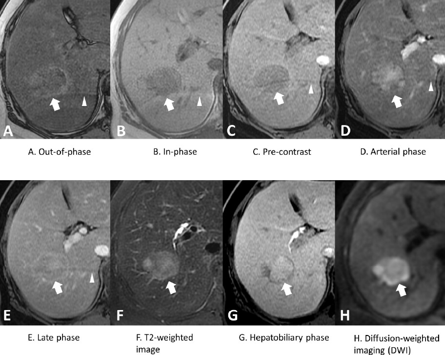 Figure 2. Gd-EOB-DTPA–enhanced magnetic resonance imaging (MRI)