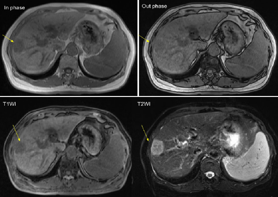 Figure 3. EOB-MRI (T1 and T2)
