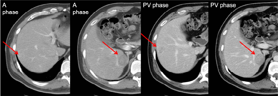 Figure 1. Two hepatic lesions in dynamic CT
