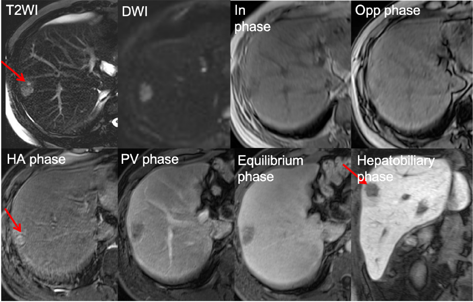 Figure 2. EOB-MRI for the S8 lesion