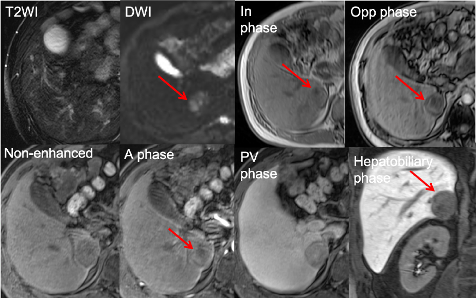 Figure 3. EOB-MRI for S6 lesion