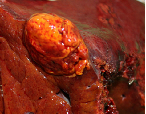 Tumor 1 (Segment 6): Hepatocellular adenoma