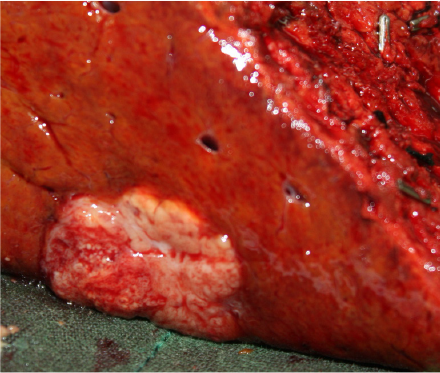 Tumor 2 (Segment 8): Hepatocellular carcinoma