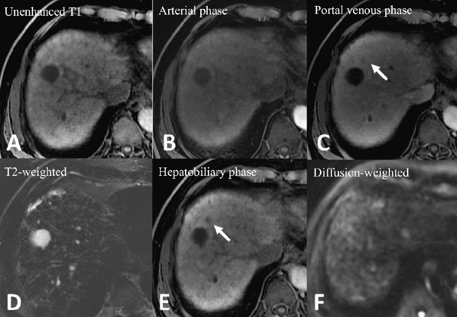 Figure 1. Gd-EOB-DTPA-enhanced magnetic resonance imaging (MRI)
