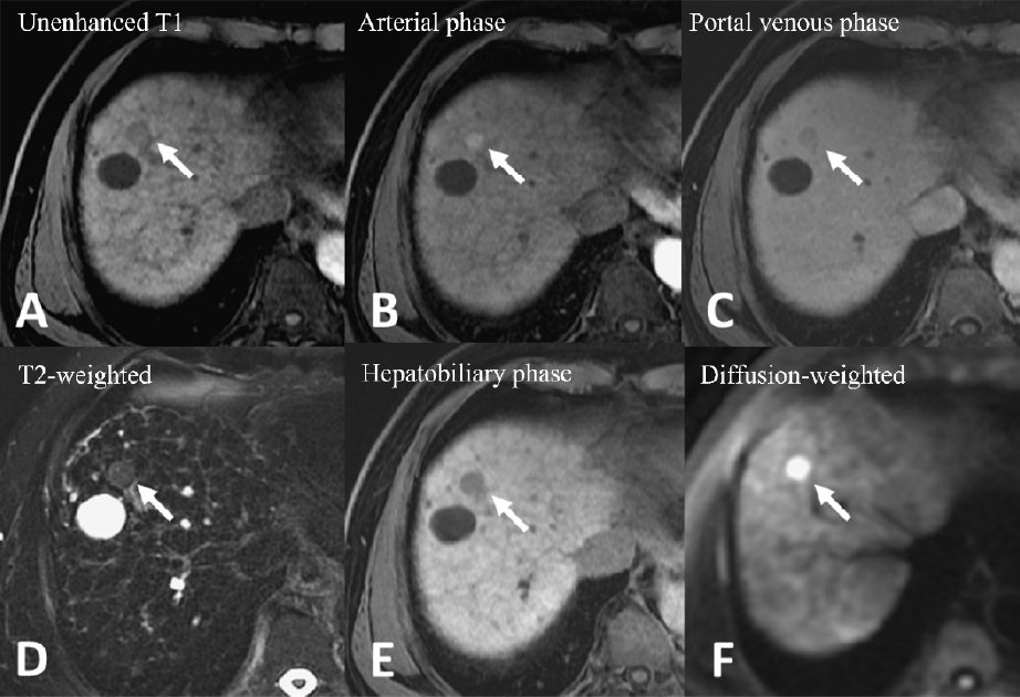 Figure 2. Gd-EOB-DTPA–enhanced magnetic resonance imaging (MRI)