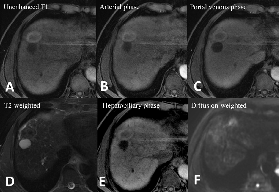 Figure 3. Gd-EOB-DTPA–enhanced magnetic resonance imaging (MRI)