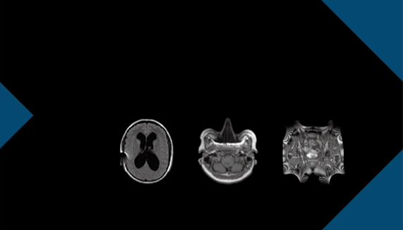 Artifacts Encountered in MRI