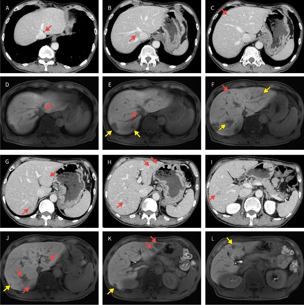 Investigation for tumors with EOB-MRI before chemotherapy