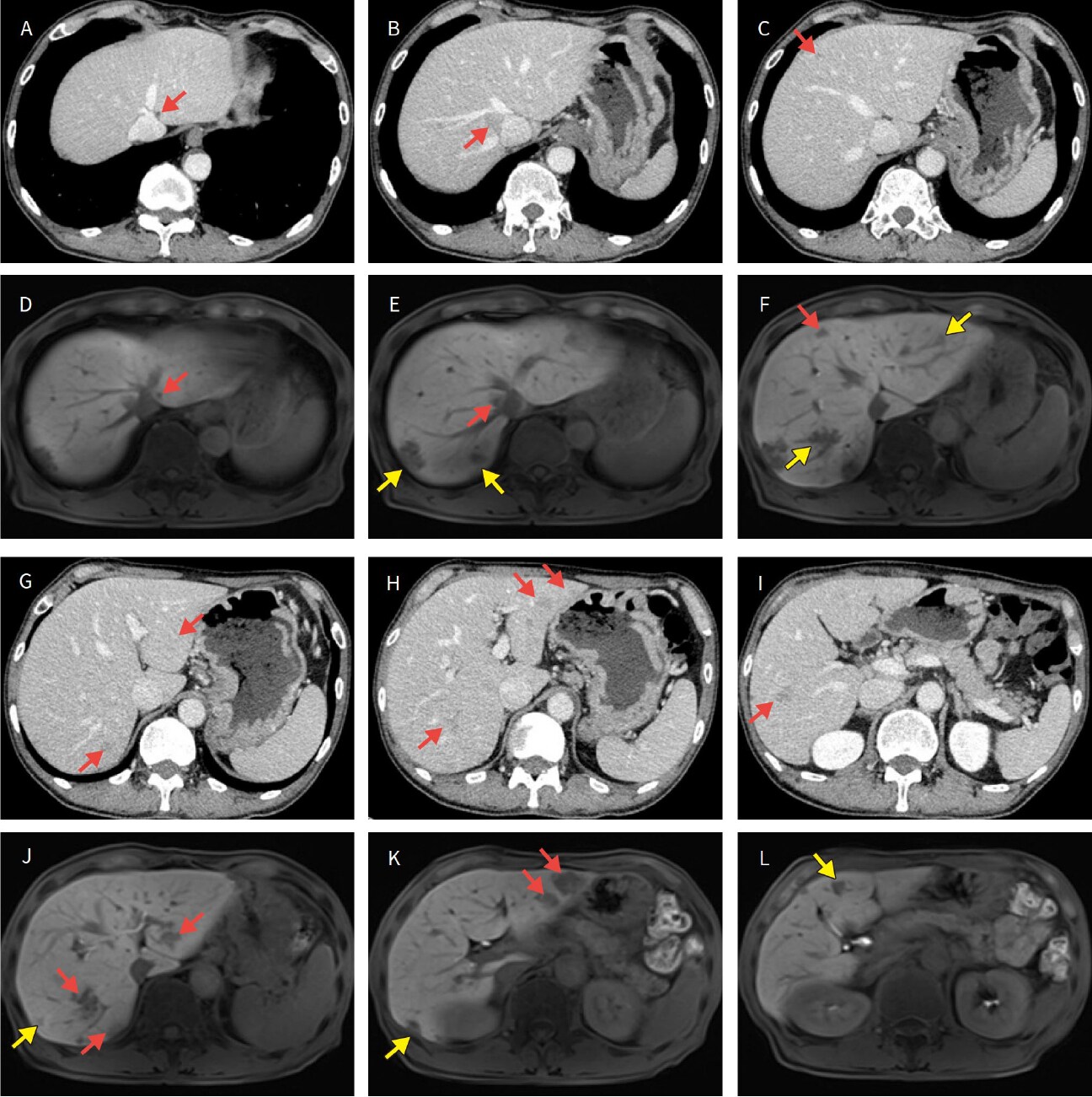T Investigation for tumors with EOB-MRI before chemotherapy