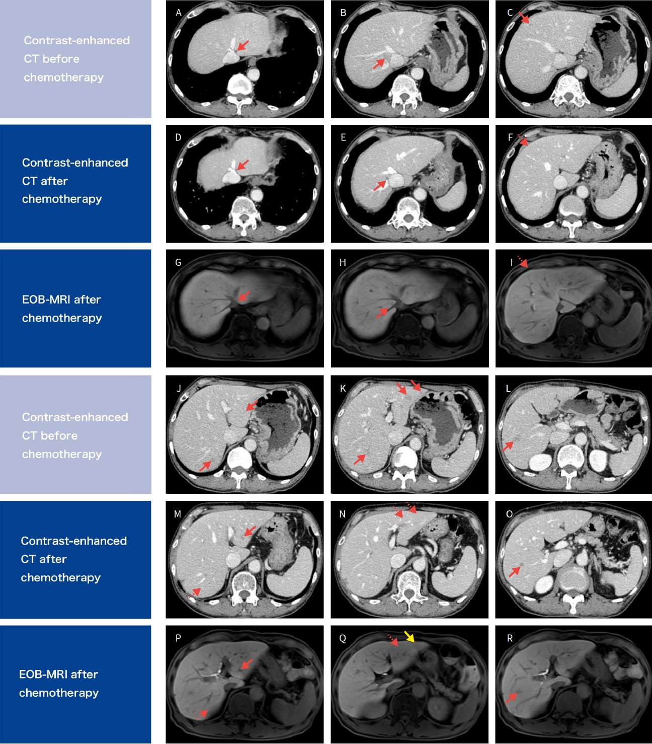 Investigation for tumors with EOB-MRI before chemotherapy