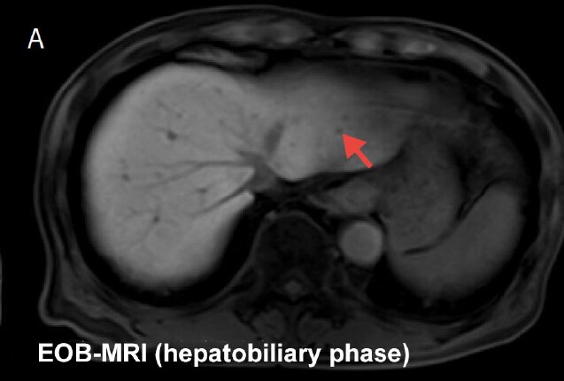 EOB-MRI