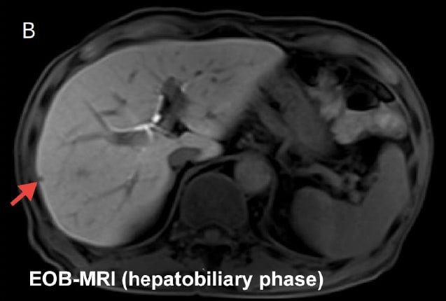 EOB-MRI