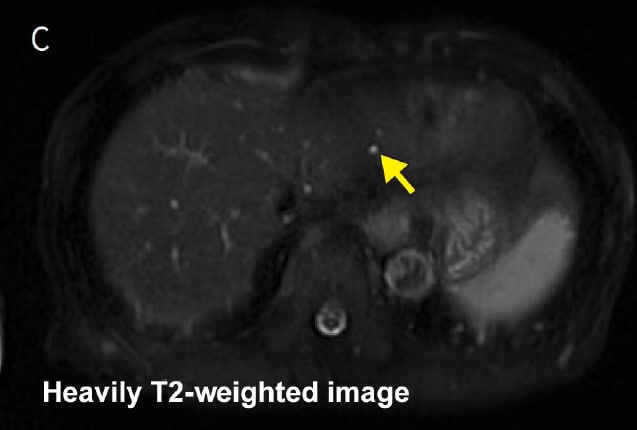 Heavily T2-weighted image