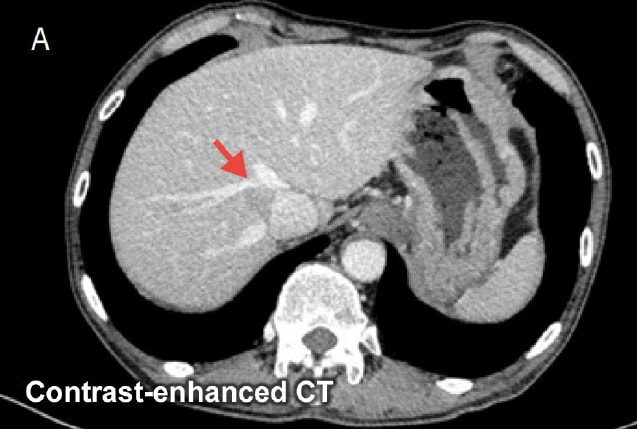 Constrast-enhanced CT