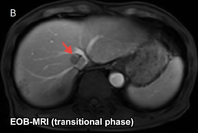 EOB-MRI (transitional phase)