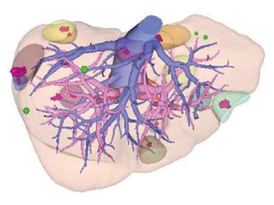 Placement of tumors confirmed by EOB-MRI on 3D-CT images