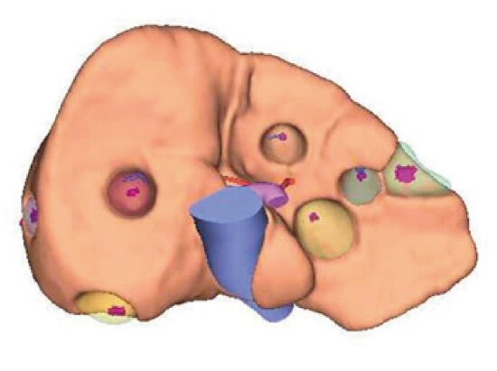 Placement of tumors confirmed by EOB-MRI on 3D-CT images