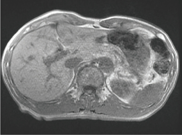 Fig. 12 T1-weighted image (in-phase, TE = 4.17 msec)