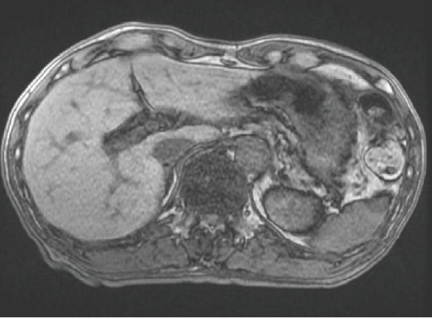 Fig. 13 T1-weighted image (out-of-phase, TE = 2.08 msec)