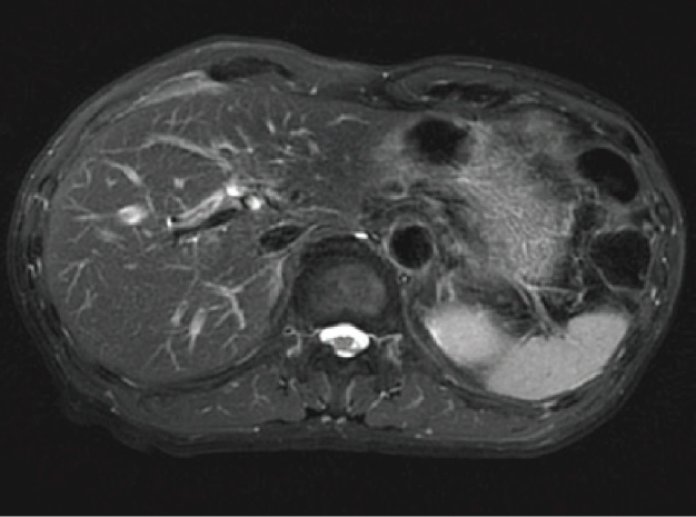 Fig. 14 Fat-suppressed T2-weighted image