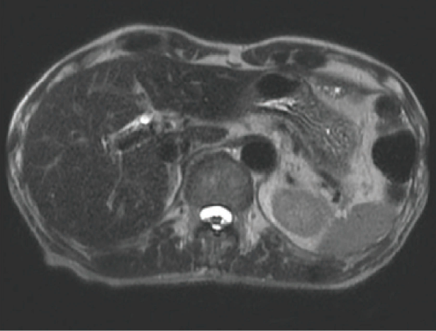 Fig. 15 Heavily T2-weighted image (TE = 150 msec)