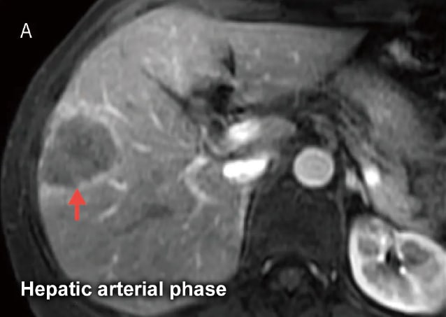 Fig. 19 Male in his 50s with metastatic liver cancer from sigmoid cancer