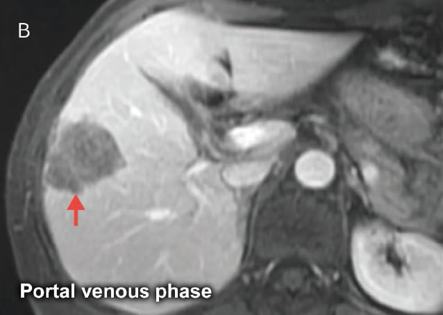 Fig. 19 Male in his 50s with metastatic liver cancer from sigmoid cancer