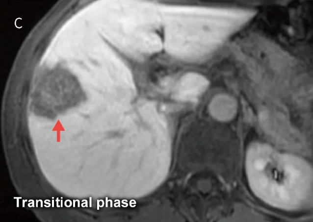 Fig. 19 Male in his 50s with metastatic liver cancer from sigmoid cancer