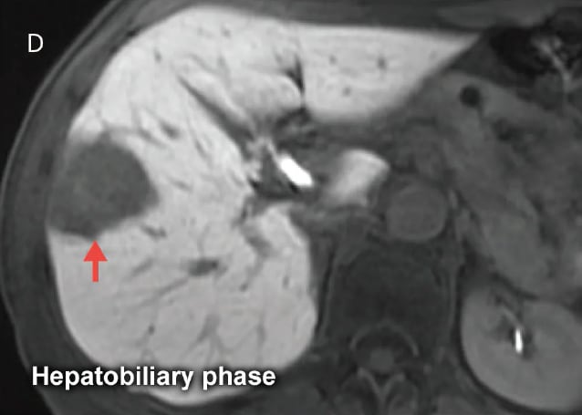 Fig. 19 Male in his 50s with metastatic liver cancer from sigmoid cancer