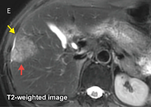 Fig. 19 Male in his 50s with metastatic liver cancer from sigmoid cancer