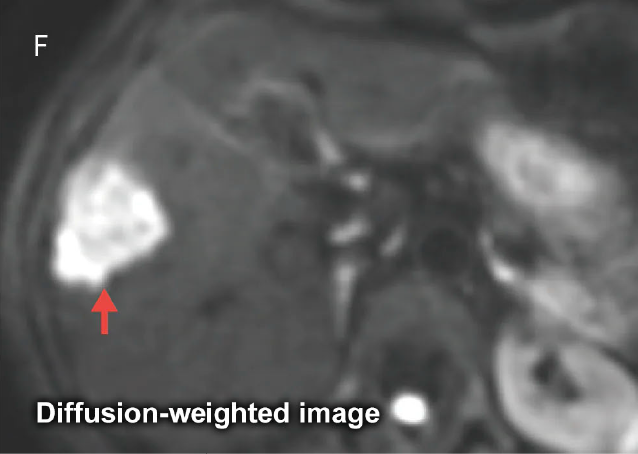 Fig. 19 Male in his 50s with metastatic liver cancer from sigmoid cancer