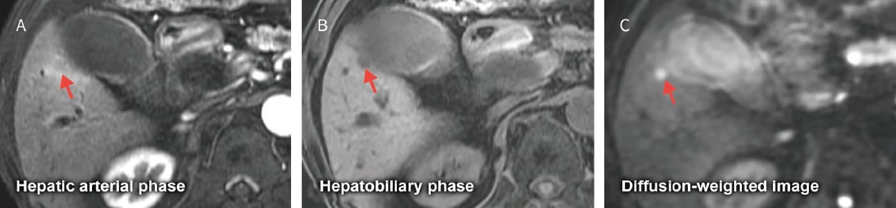 Fig. 20 Male in his 70s with metastatic liver cancer from pancreatic head cancer