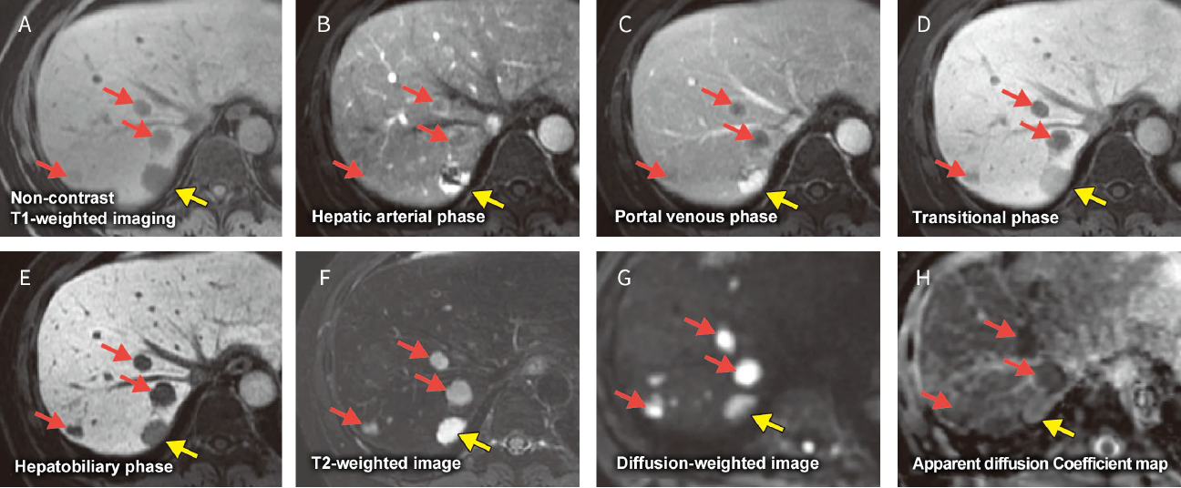 Fig. 22 Male in his 50s with a cavernous hemangioma and multiple liver metastases from pancreatic cancer