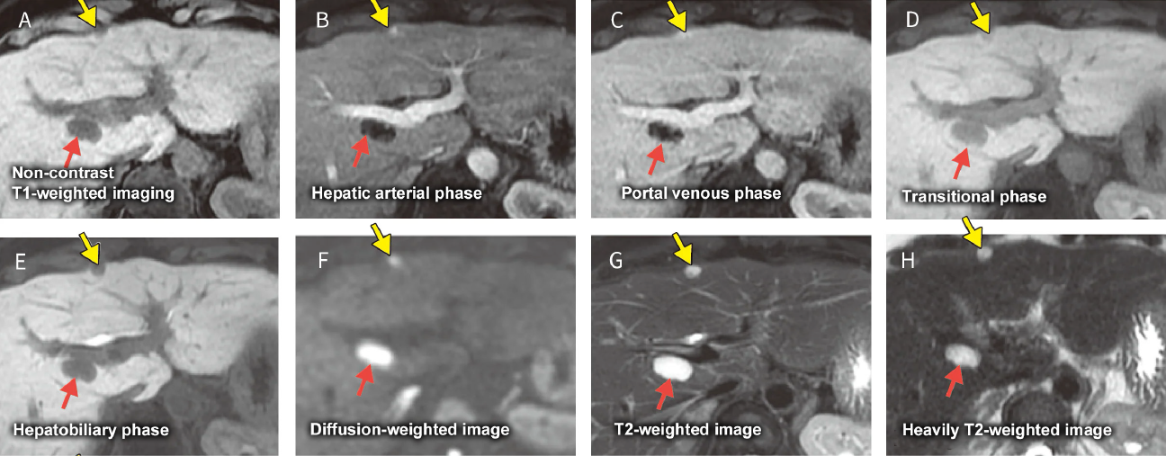 Fig. 23 Male in his 60s with hepatic cavernous hemangiomas