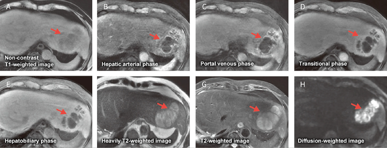 Fig. 24 Male in his 60s with a liver abscess