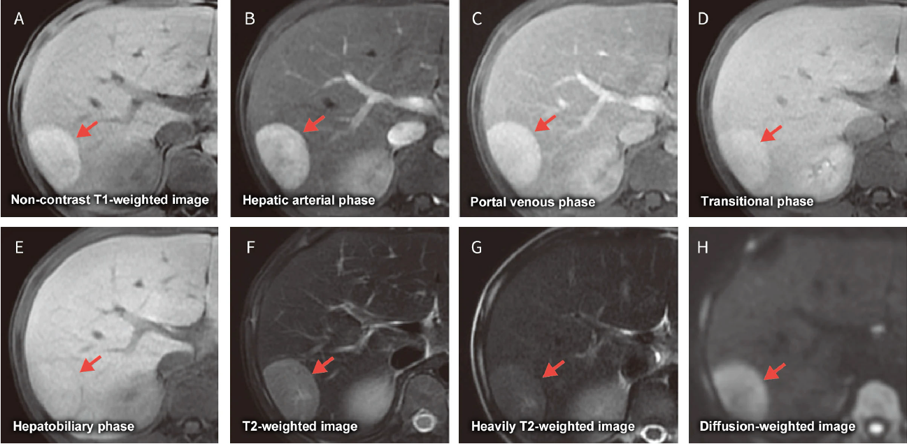 Fig. 26 Male in his 10s with hepatocellular adenoma (classication unknown) secondary to type I glycogen storage disease