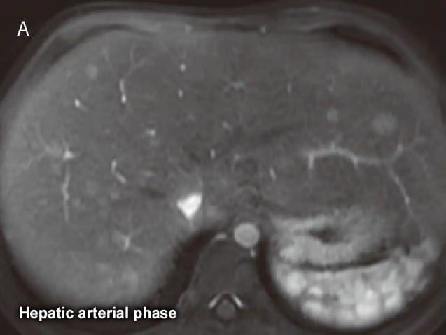 Fig. 27 Male in his 10s with multiple hepatocellular adenomas (classication unknown) secondary to type I glycogen storage disease