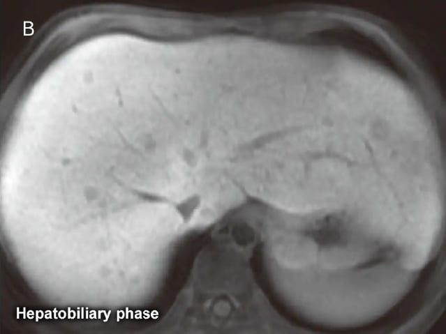 Fig. 27 Male in his 10s with multiple hepatocellular adenomas (classication unknown) secondary to type I glycogen storage disease