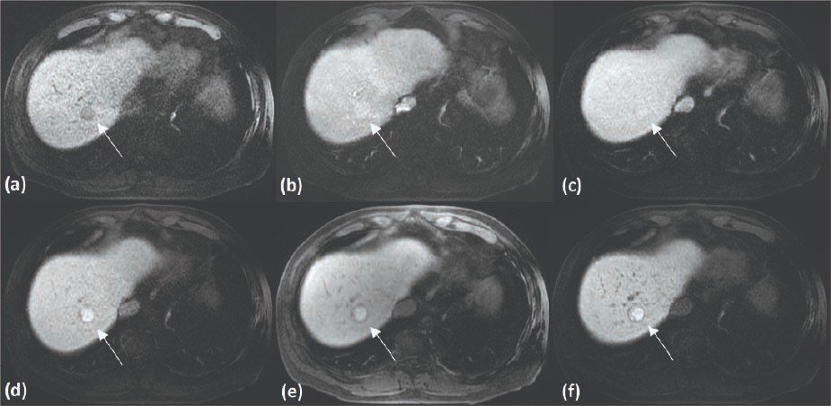 Figure 1. EOB-MRI T1-weighted image (T1WI), pre- and post-contrast dynamic phase