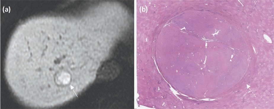 Figure 3. Different hyperintense appearance between HCC and FNH