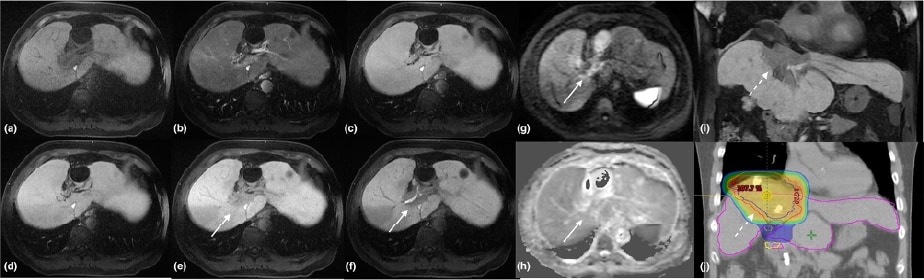 Figure 2. EOB-MRI 1 year after PBT, post-contrast dynamic study