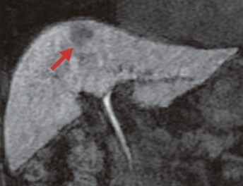 S8: Hepatobiliary phase (h)