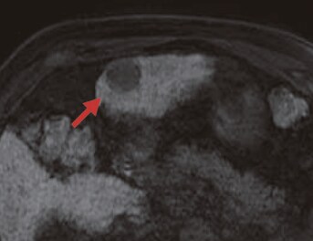 S3: Hepatobiliary phase (i)