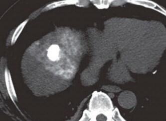 S8: Simple CT (k) immediately after TACE